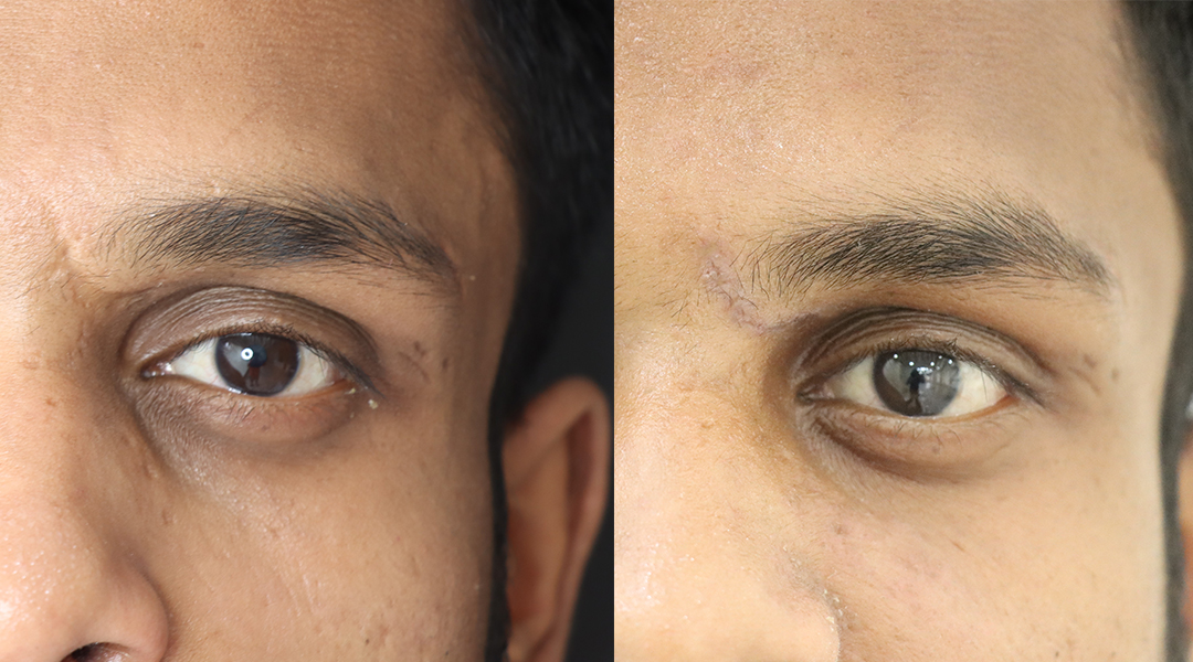 Alar Reduction result KOQ10